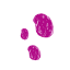 seborrheic ketatosis